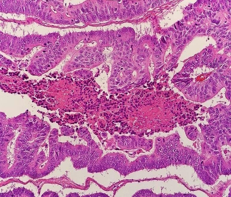 Colorectal adenocarcinoma